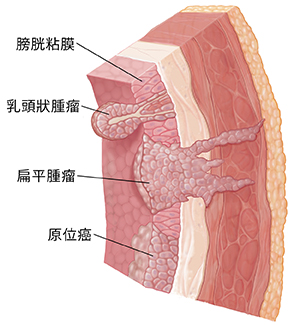 膀胱壁剖面圖，顯示粘膜層、黏膜下層、肌層、脂肪、和三種癌症：乳頭狀腫瘤，無蒂腫瘤，和原位腫瘤。