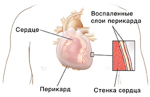 Вид человеческой груди с изображением сердца и перикарда. Поперечный разрез крупным планом, показывающий два слоя воспаленного перикарда с жидкостью между ними на верхней части стенки сердца.