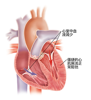 患舒張性心力衰竭的心臟的橫截面。