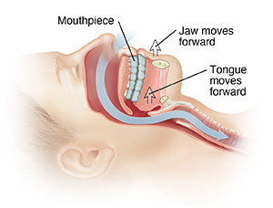 Side view of head with arrow showing path of air through nasal passages into trachea. Arrows show oral appliance moving lower jaw forward.