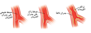 مقطع عرضي للشريان به أسهم تُظهر ضغط الدم الطبيعي على الجدران الداخلية. مقطع عرضي للشريان به أسهم تُظهر ضغط الدم المرتفع على الجدران الداخلية. مقطع عرضي للشريان يُظهر البطانة التالفة وتراكم اللويحات.