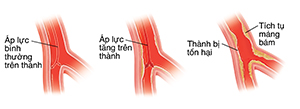 Mặt cắt ngang của động mạch với các mũi tên cho thấy huyết áp bình thường trên các thành bên trong. Mặt cắt ngang của động mạch với các mũi tên cho thấy huyết áp cao ở thành bên trong. Mặt cắt ngang của động mạch cho thấy lớp niêm mạc bị tổn thương và mảng bám tích tụ.
