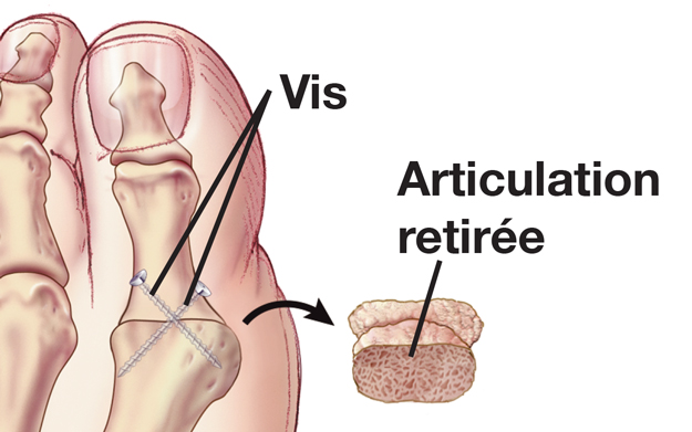 Articulation enlevée et vis ajoutées sur un gros orteil