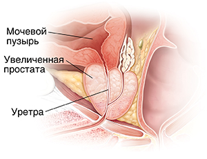 Поперечное сечение увеличенной предстательной железы.