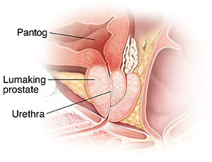 Cross section ng lumaking prostate gland.